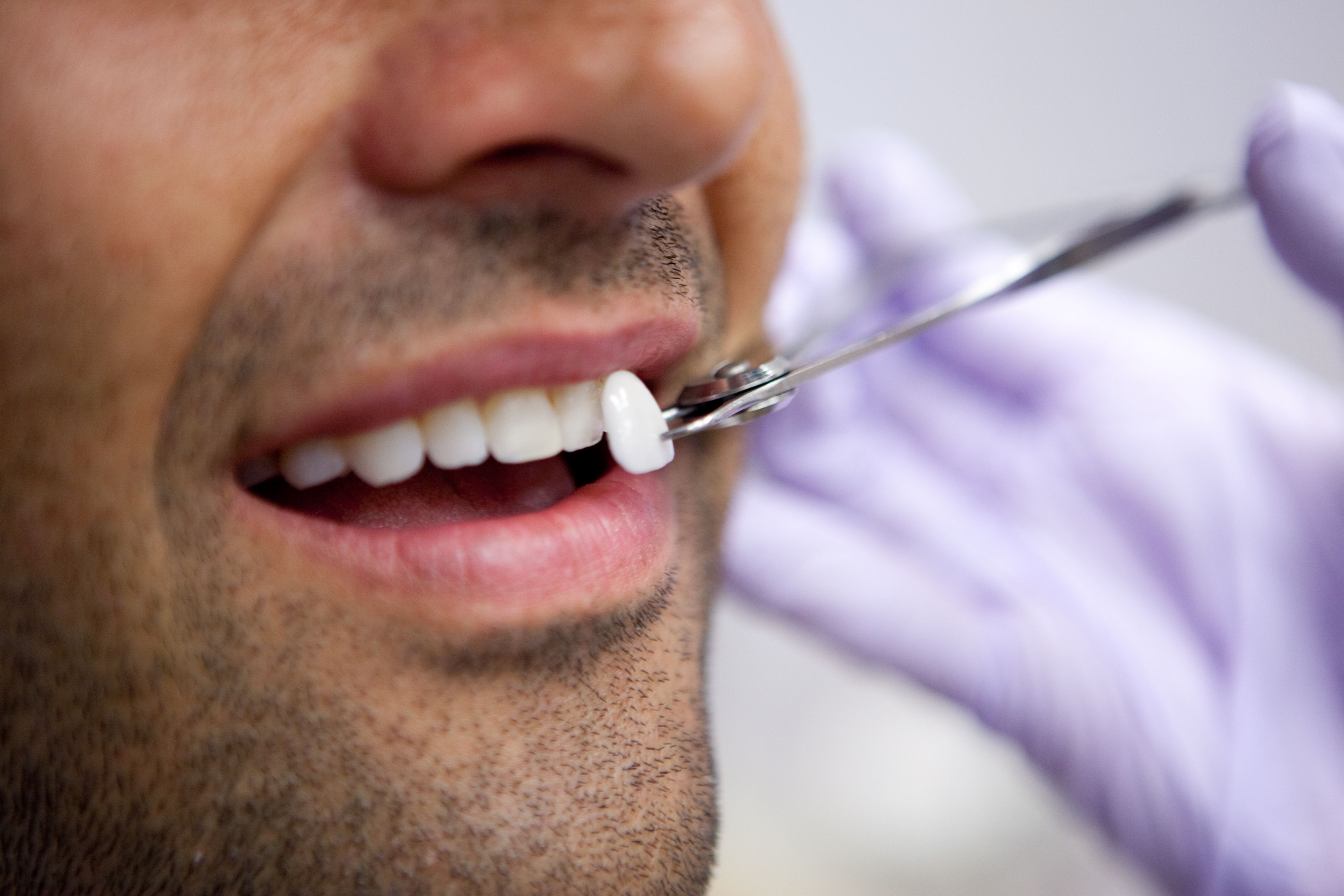 What is the cost of dental veneers?