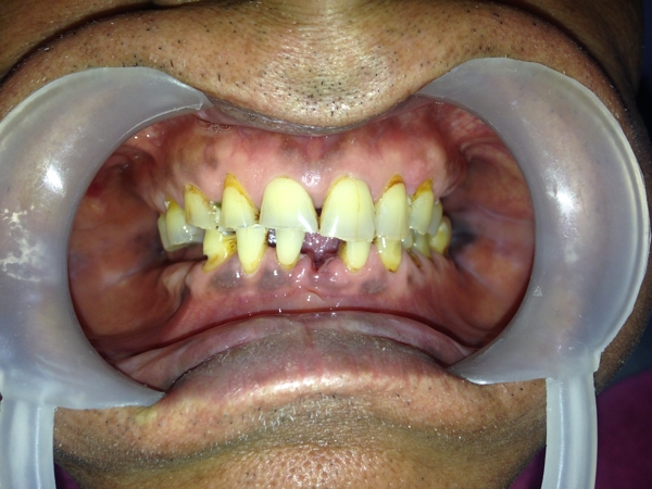 Before-Full Mouth Rehabilitation