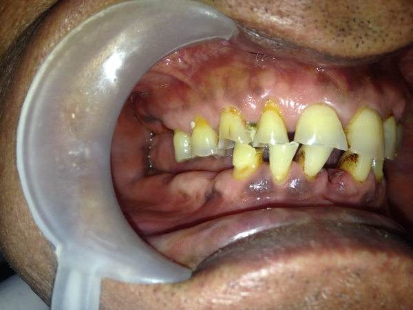 Before-Full Mouth Rehabilitation