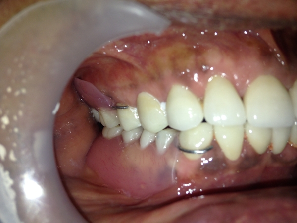 After-Full Mouth Rehabilitation