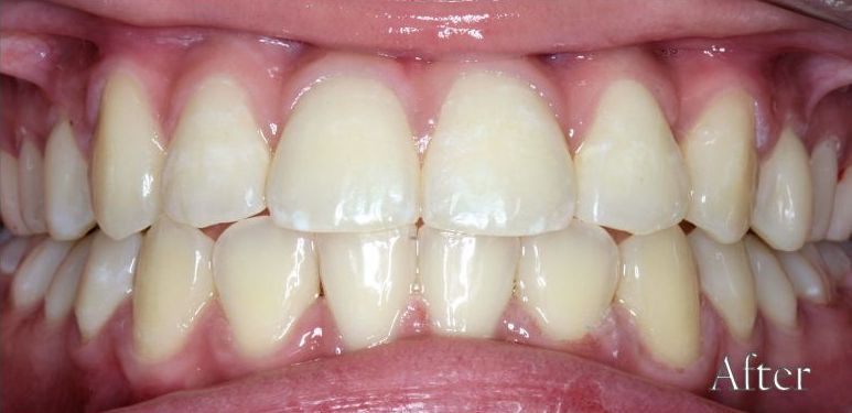 After-Orthodontic Treatment