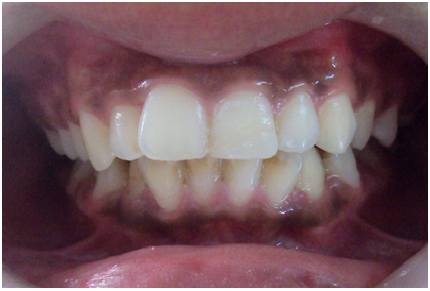 After-Tooth Coloured Filing