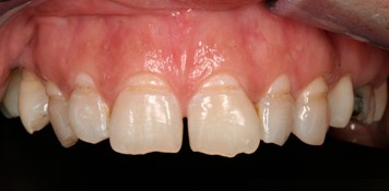 Before-Tooth Contouring